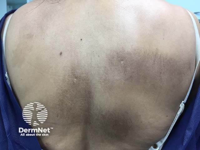 Очаги макулярного (пятнистого) амилоидоза на коже спины