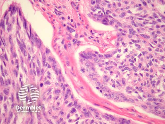 Рисунок 2. Выявление злокачественных меланоцитов с выраженными ядрышками в структуре опухоли при большом увеличении.