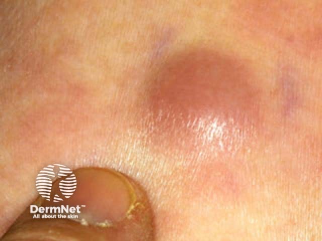 Лейкемиды кожи (leukaemia cutis)