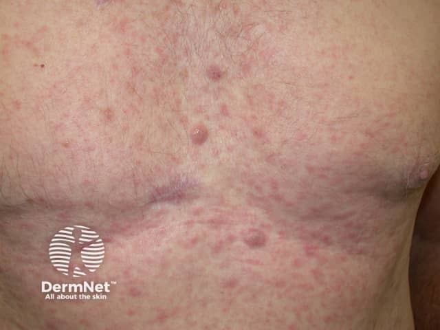 Лейкемиды кожи (leukaemia cutis)
