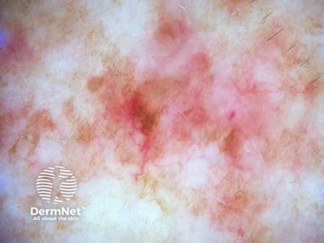 Дерматоскопическая картина: выраженная телеангиэктатическая сеть при телеангиэктатическом варианте пятнисто-папулезного кожного мастоцитоза