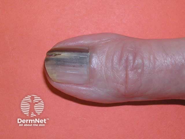 Меланома ногтевого аппарата с деформацией пластинки