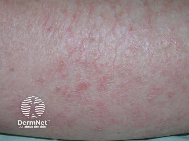 Сухость, эритема и шелушение при астеатотической экземе в постменопаузе