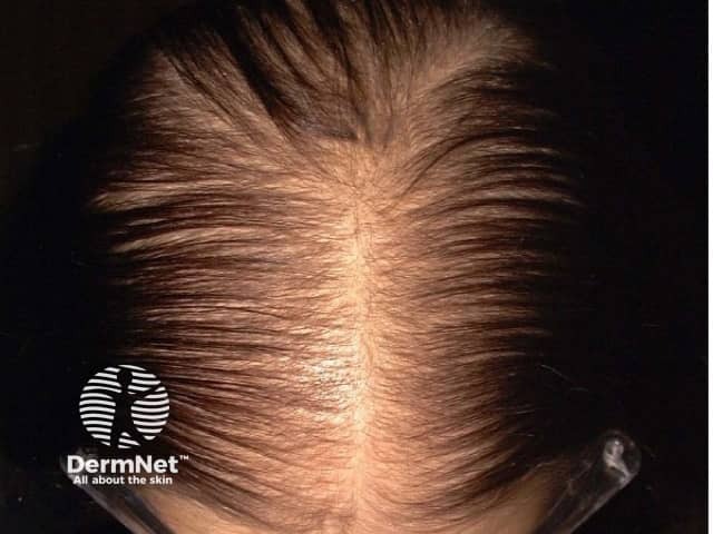 Диффузное поредение волос в теменной зоне вследствие алопеции по женскому типу, прогрессирующей после наступления менопаузы