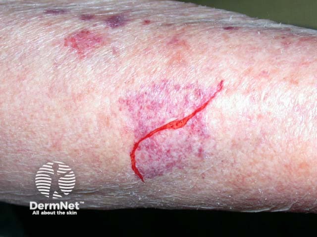 Повышенная хрупкость кожи и легкое образование гематом (экхимозов) из-за ускоренной потери коллагена чаще наблюдаются у женщин в постменопаузе