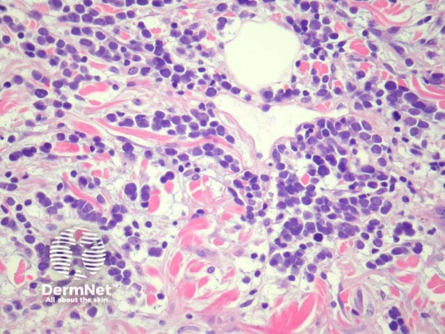 Рисунок 4. Высокое увеличение: мономорфная популяция недифференцированных нейроэндокринных клеток, симулирующих лимфоидный инфильтрат.