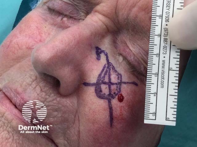 Клинически видимая базальноклеточная карцинома очерчена с хирургическим отступом, нанесена координатная сетка для картирования
