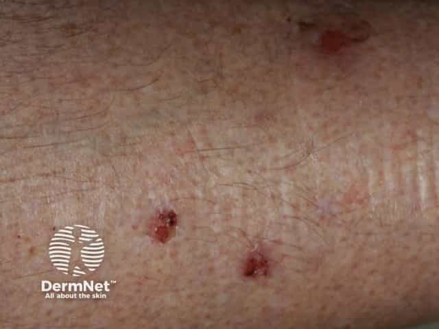 Небольшие эрозии, из которых пациентом извлекались «волокна» из кожи