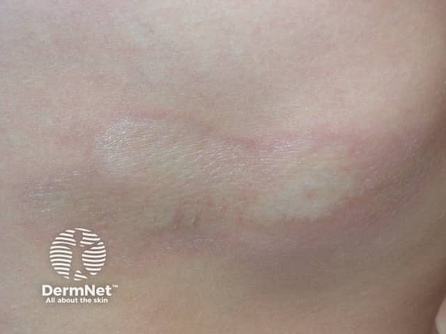 Очаговая склеродермия: активная стадия с характерным фиолетово-сиреневым венчиком воспаления
