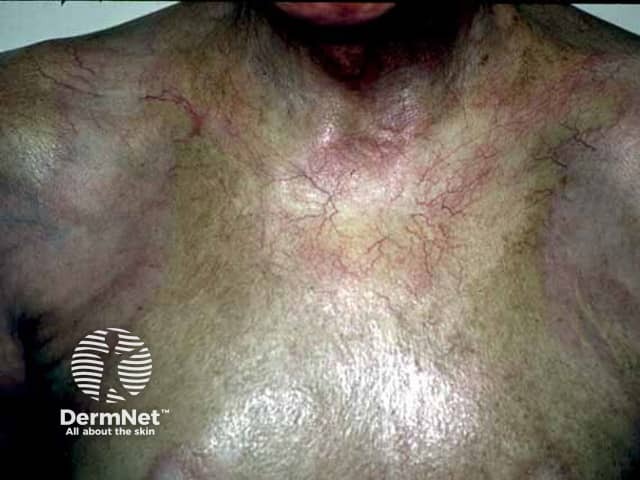 Генерализованная морфеа: множественные сливные склеротические очаги