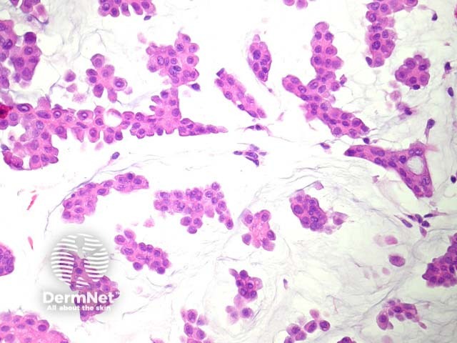 Рисунок 3. Цитологические детали муцинозной карциномы: умеренный клеточный плеоморфизм и эозинофильная цитоплазма при большом увеличении.