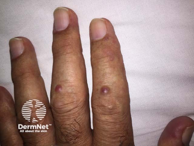Мультицентрический ретикулогистиоцитоз