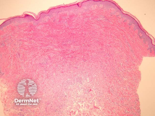 Рисунок 1. Гистологическая картина многоядерной ангиогистиоцитомы: расширенные кровеносные сосуды и фиброплазия в дерме.