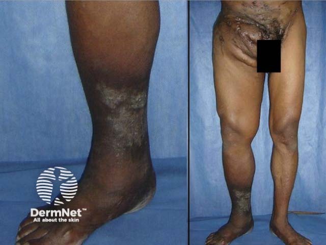 Актиномицетома стопы и голени