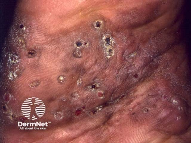 Актиномицетома, вызванная Nocardia