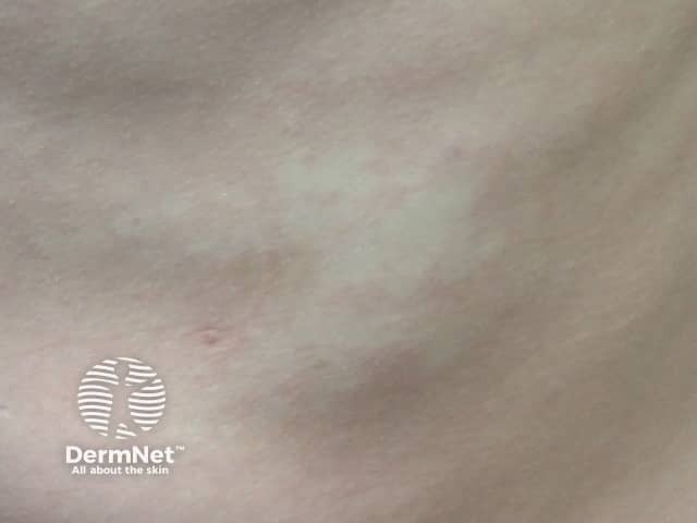 Анемический невус с фестончатыми границами
