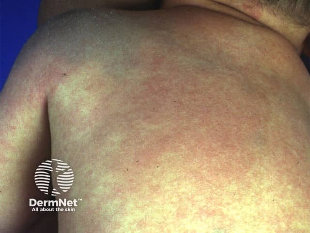 Невус Ито в области надплечья и лопатки