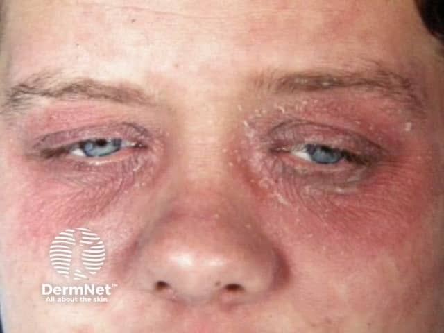 Дерматит век вследствие аллергии на лак для ногтей