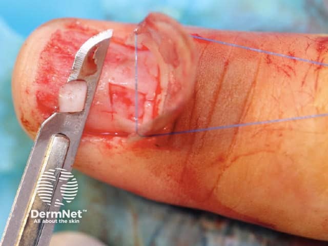 Рисунок 6. Размещение маркированного биоптата в контейнере с формалином
