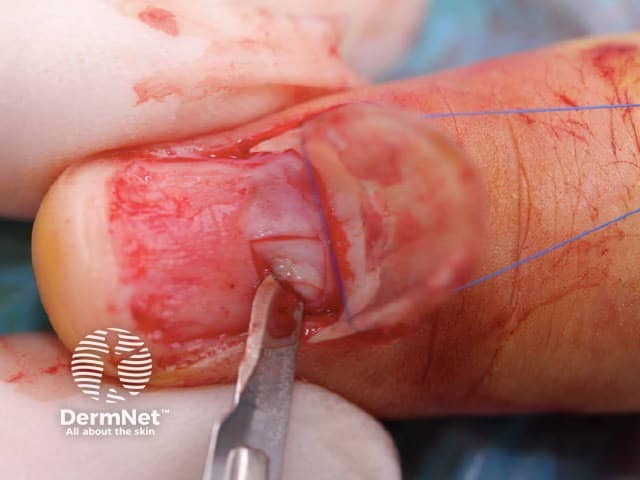 Рисунок 5. Тангенциальный забор биоптата матрикса скальпелем