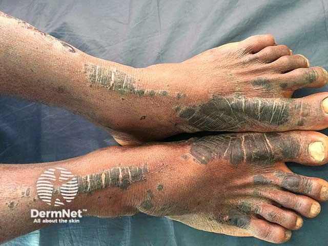 Некролитическая акральная эритема, клинический случай 003