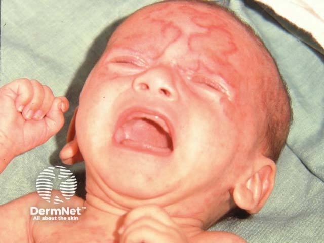 Кольцевидная сыпь, напоминающая подострую кожную красную волчанку