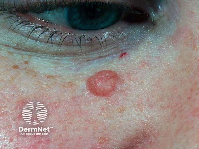 Нодулярная базальноклеточная карцинома