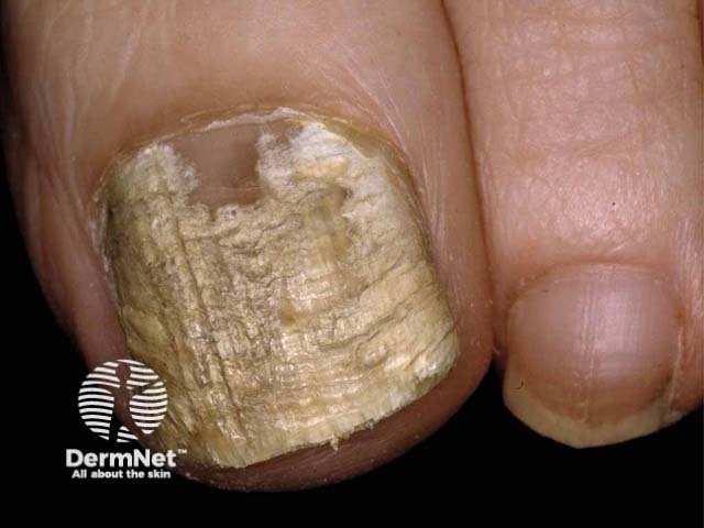 Инфекция, вызванная Fusarium (фузариозный онихомикоз)