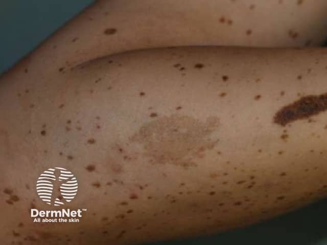 LEOPARD-синдром: характерные клинические дерматологические проявления