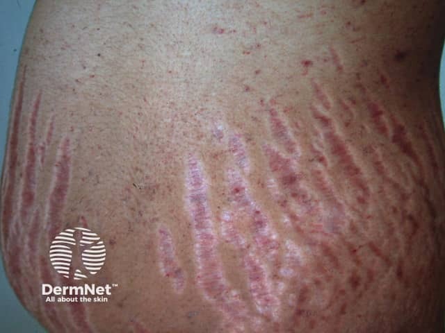 Стрии (растяжки / striae distensae)