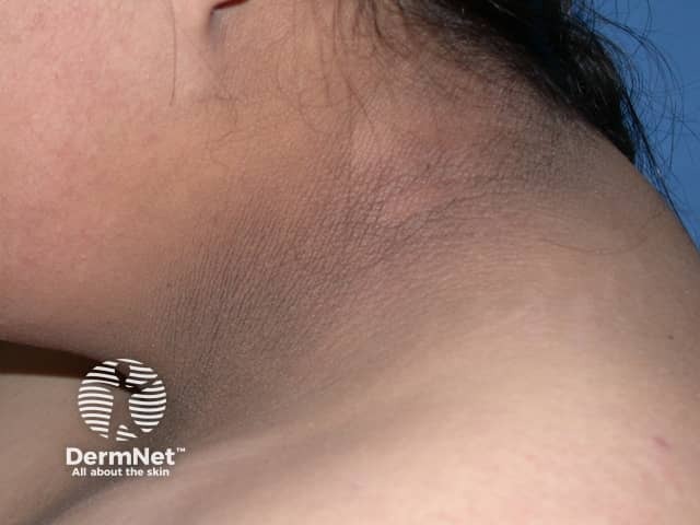 Черный акантоз (Acanthosis nigricans)