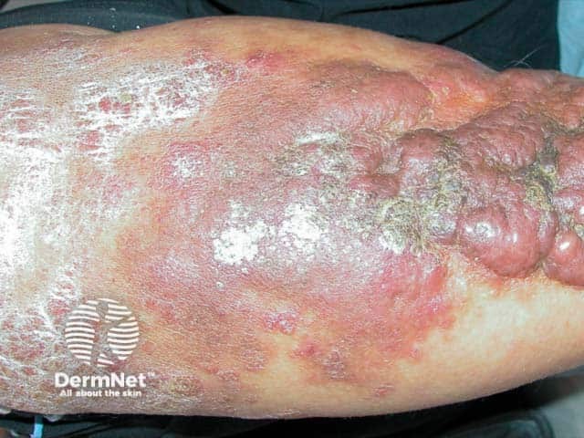 Выраженные бляшки на коже голеней при ассоциированном с ожирением лимфедематозном муцинозе: функция щитовидной железы всегда оставалась в норме, тиреоидные антитела отрицательные