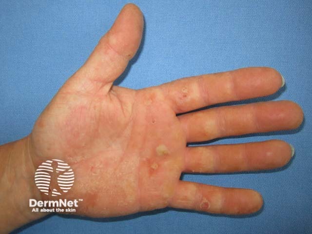 Дерматит кистей вследствие аллергии на компоненты резиновых перчаток