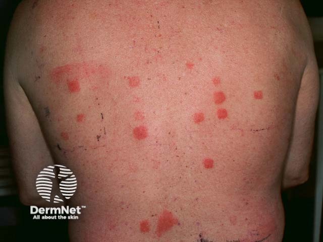 Положительные аппликационные пробы (патч-тесты) на акрилаты у врача-стоматолога