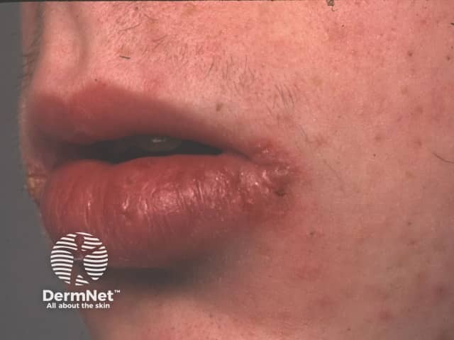 Гранулематозный хейлит, обусловленный болезнью Крона