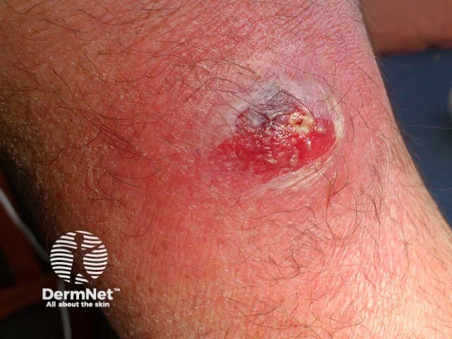 Крупный болезненный фурункул, посев содержимого которого выявил штамм PVL-SA
