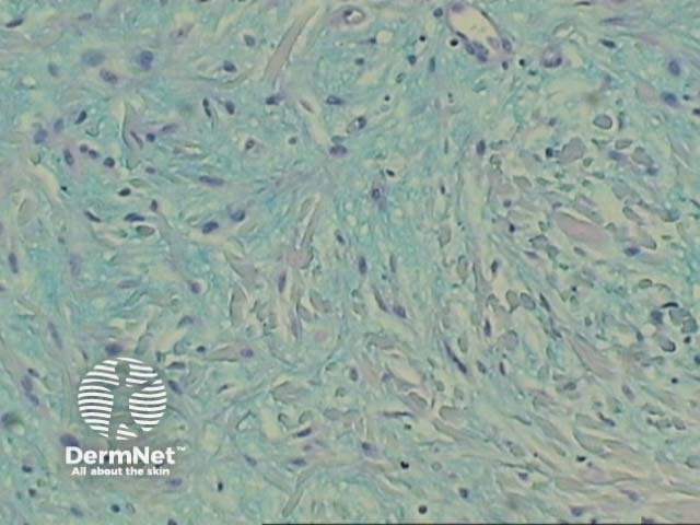 Рисунок 3. Окрашивание альциановым синим (выявление депозитов муцина)