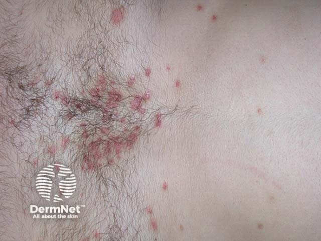 Хронический бляшечный псориаз средней степени тяжести