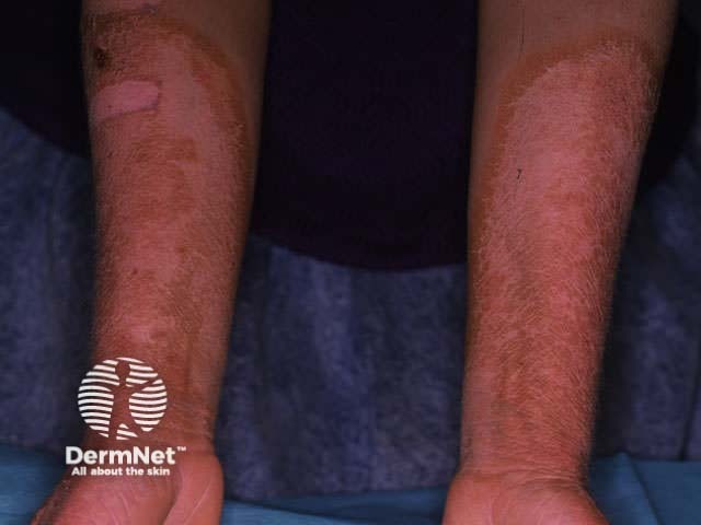 Пеллагра: симметричный фоточувствительный эритематозно-сквамозный дерматит