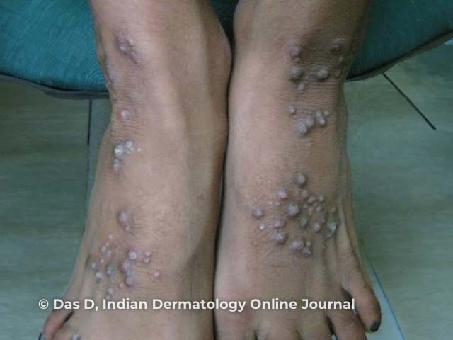 Узловатый пемфигоид (Pemphigoid nodularis)