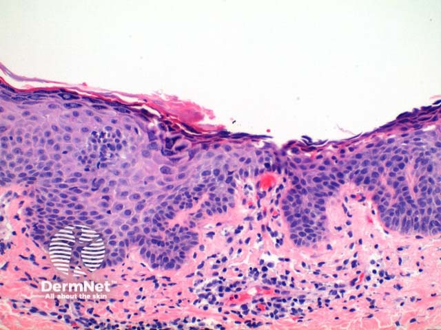 Рисунок 5. Деталь строения акантолитических клеток зернистого слоя при листовидной пузырчатке.