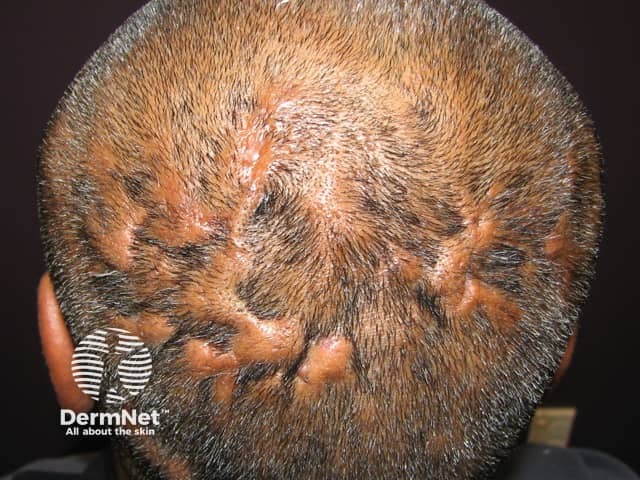 Рассекающий целлюлит волосистой части головы: выраженный отек, болезненные инфильтраты