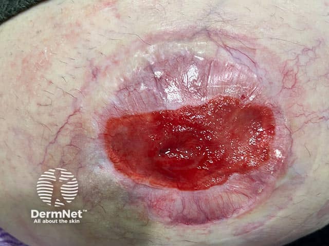 Четко отграниченные грануляционные разрастания вокруг илеостомы