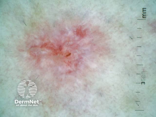Дерматоскопия поверхностного базальноклеточного рака кожи