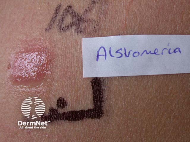 Положительная реакция при аппликационном тестировании (патч-тесте)