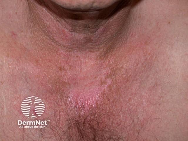 Клинические проявления фотосенсибилизации на открытых участках тела