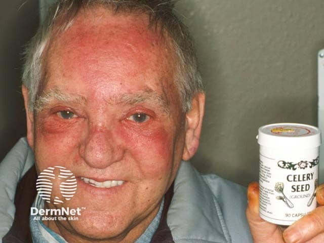 Фотосенсибилизация, вызванная семенами сельдерея