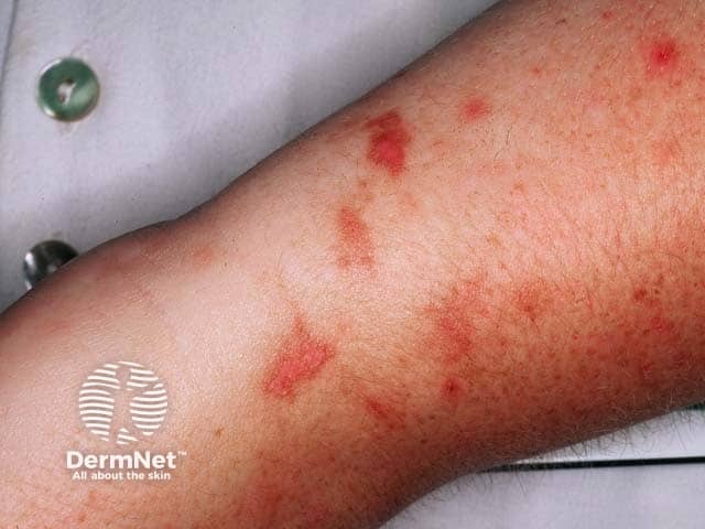 Эритема с зазубренными краями при фитофотодерматите