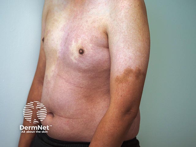 Капиллярная мальформация на грудной клетке и эпидермальный невус на руке при мутации PIK3CA