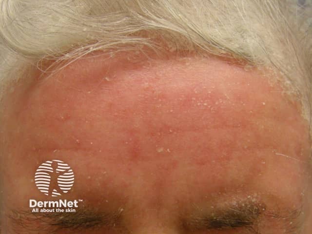 Питириазиформный себореид: генерализованные шелушащиеся эритематозные пятна